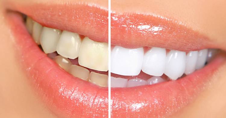 Clareamento dental - Mitos e verdades e o passo a passo correto!