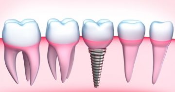 Implantes dentários