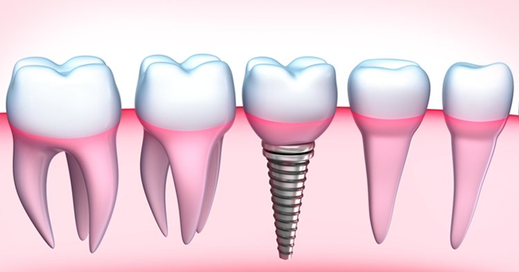 Implantes dentários em Santo André - Rubi Odonto