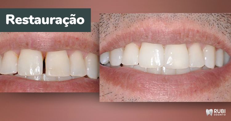 Restauração dentária em Santo André, SP - Rubi Odonto