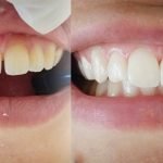 restauracao-dentaria-dentista-santo-andre-rubi-odonto