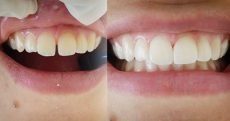 Restauração dentária