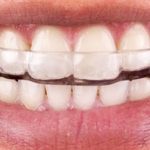 Bruxismo - Rubi Odonto - Dentista em Santo André