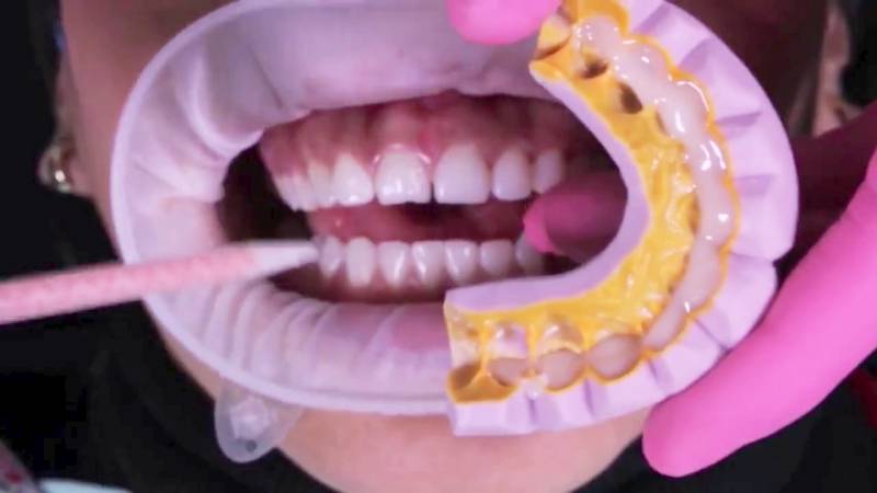 harmonia do sorriso - lentes de contato dental - Dentista em Santo André - Rubi Odonto