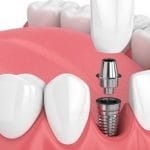 Implante dentário, preço e o que mais você precisa saber.