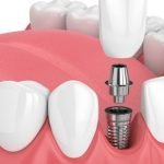 Implante Dentário Preço, Dentista em Santo André – Rubi Odonto