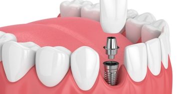 Implante dentário, preço e o que mais você precisa saber.
