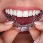 Alinhador invisível – rubi odonto dentista santo andre