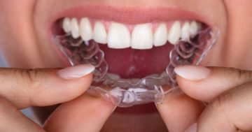 Aparelho invisível – Invisalign e Esthetic Aligner