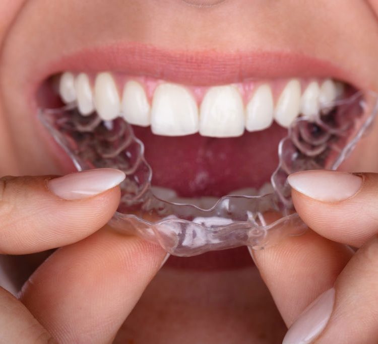 Aparelho invisível – Invisalign e Esthetic Aligner