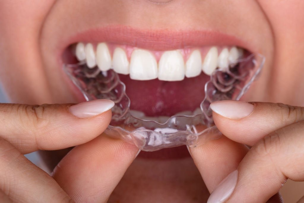 Aparelho invisível Esthetic Aligner: conheça a tecnologia que vai revolucionar o seu sorriso